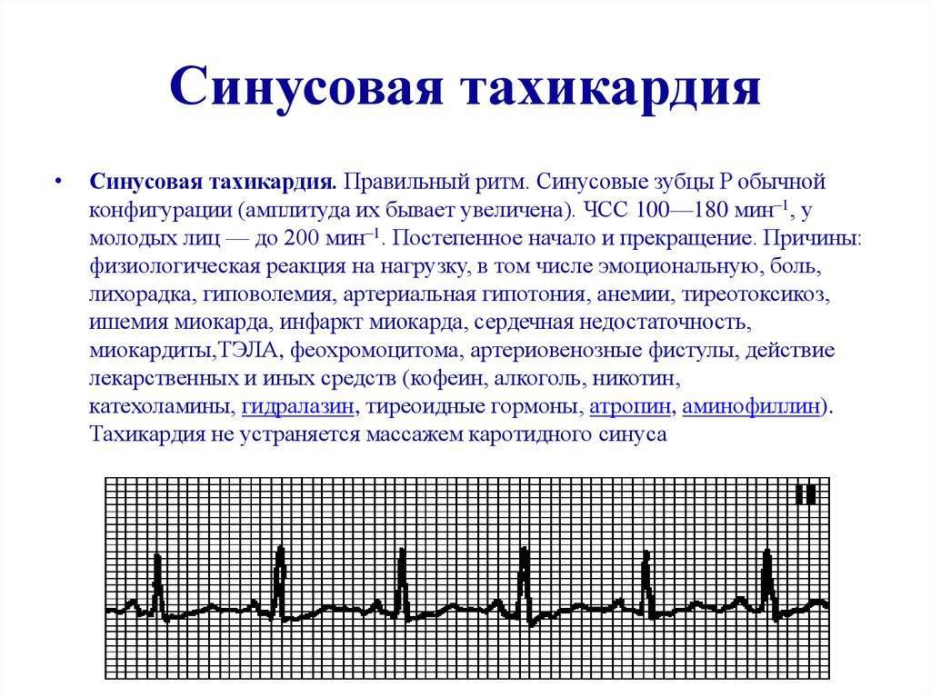 Синусовая аритмия сердца | медицинский центр «президент-мед»
