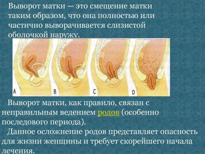 Лечение опущения матки - цена 1800 руб. лечения выпадения матки в москве  консервативное лечение опущения передней стенки матки