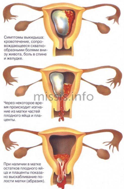 Гинекологическое выскабливание полости матки