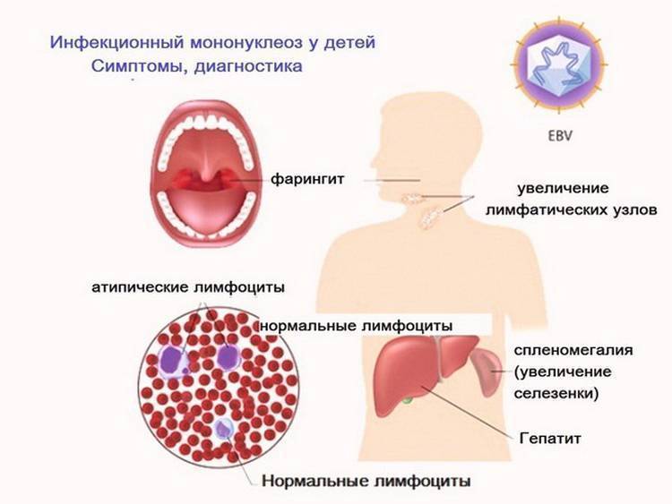 Энтеровирусная инфекция: причины, симптомы, лечение
