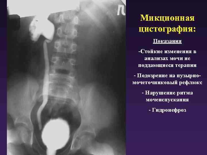 Пузырно мочеточниковый рефлюкс у детей презентация