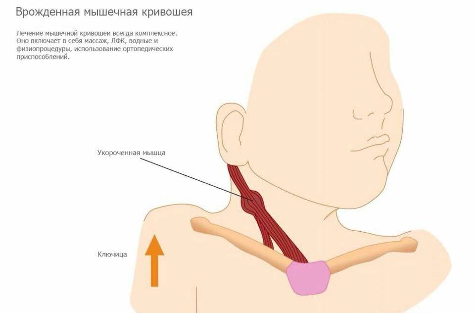 Кривошея у новорожденных: признаки, причины, лечение, массаж, фото