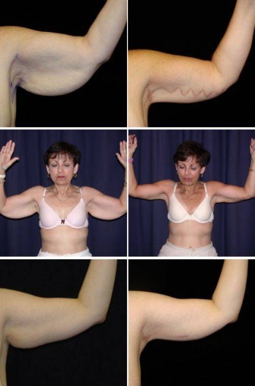 Грудь после родов: как быстро подтянуть грудь, фото, методы подтяжки груди, отзывы