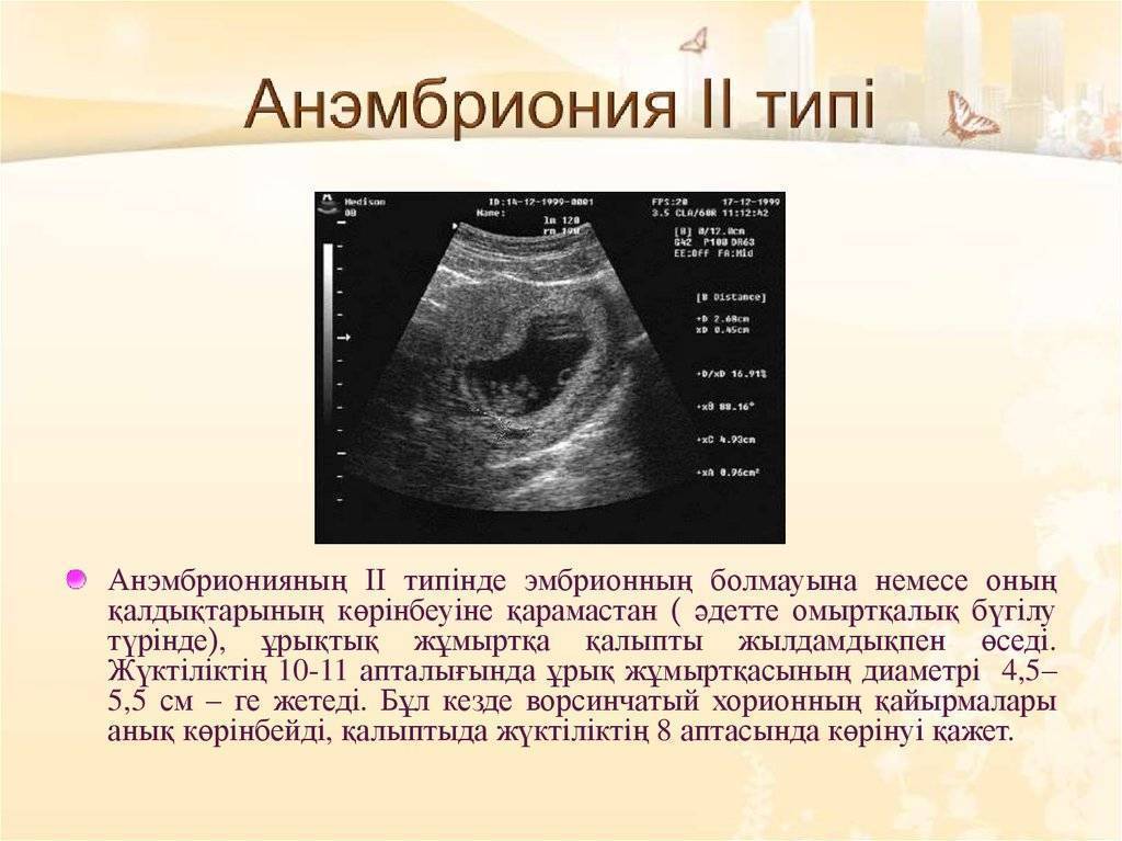 Генетическая диагностика ворсин хориона замершей беременности / москва