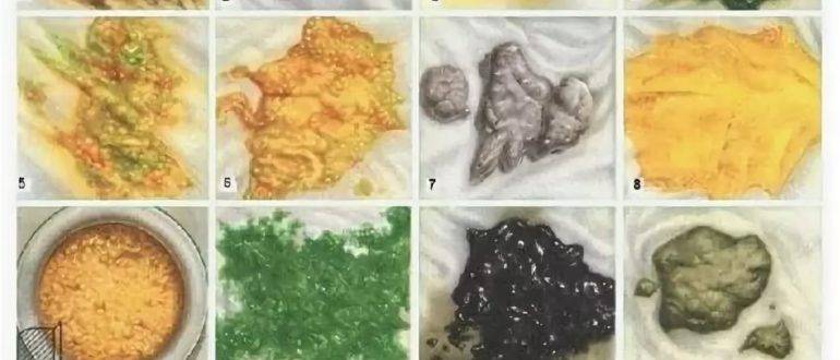 Кал при раке кишечника: цвет кала при онкологии, форма кала при раке кишечника, фото кала при раке кишечника