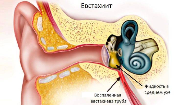 Боль в ушах при простуде