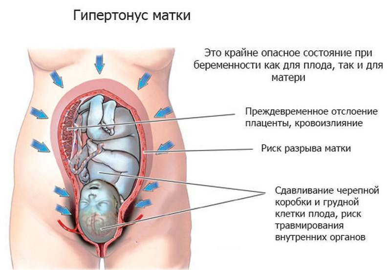 Гипертонус матки при беременности: причины, симптомы
