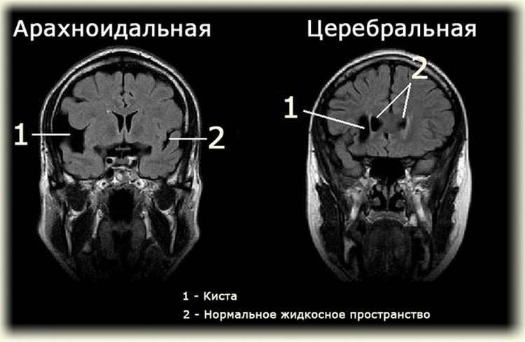 Киста головного мозга у взрослого, ребенка, новорожденного. симптомы и лечение, чем опасна киста в голове - medside.ru