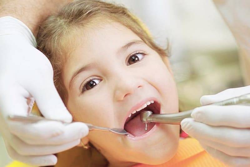 Лечение пульпита молочного зуба в два посещения, лечение пульпита у детей.