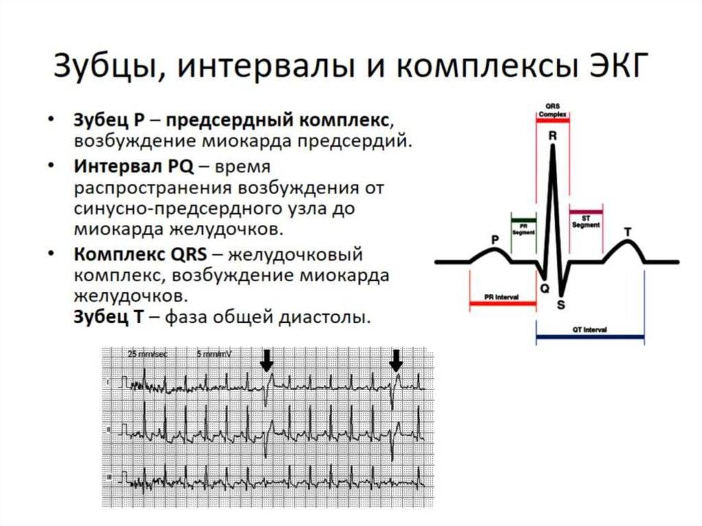 Расшифровка экг: наиболее важные показатели кардиограммы с примерами нарушений
