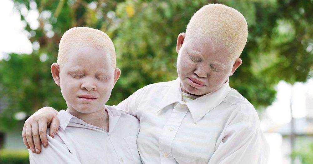 Альбинос: кто такой, 3 типа альбинизма, способы лечения и советы
