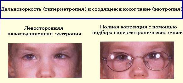 Какие меры предпринять, чтобы остановить процесс развития косоглазия?