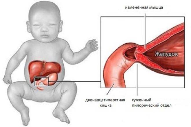 Основные клинические проявления при врождённом пилоростенозе и эффективные методы лечения