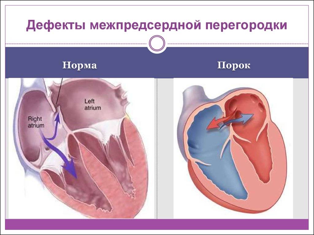 Пороки сердца у детей: аневризма межпредсердной перегородки