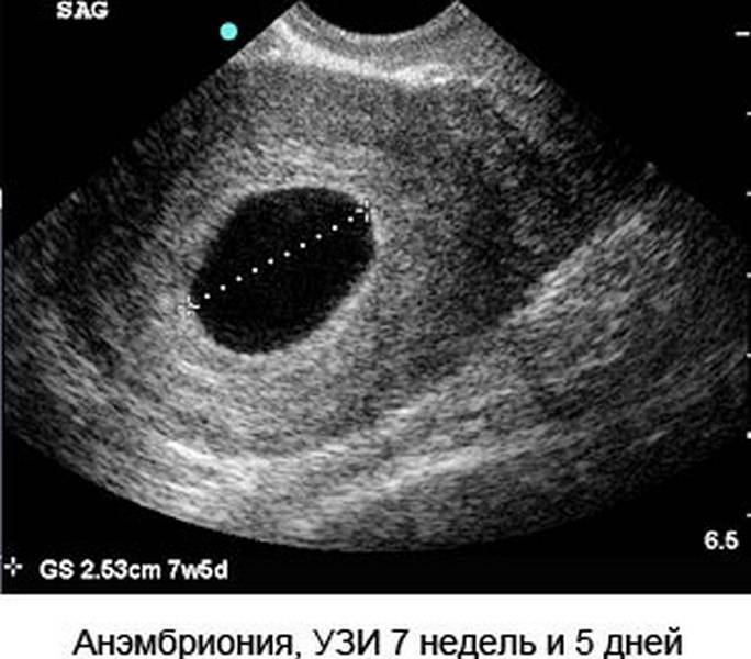 Анэмбриония или почему не видно эмбриона на узи - статья репродуктивного центра «за рождение»