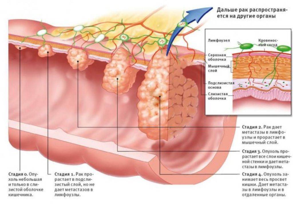 Метастазы в лимфоузлах брюшной полости, забрюшинного пространства и малого таза – лечение