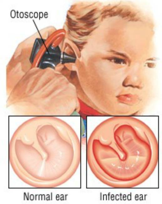 Снижение слуха у ребёнка: причины ухудшения и плохого слуха при отите и насморке, лечение аденоидов у детей от 4 лет