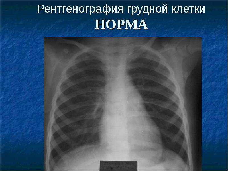 Зачем делать рентген грудной клетки: причины назначения врачом данной процедуры