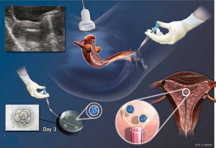 Беременность после переноса эмбрионов из «пробирки»