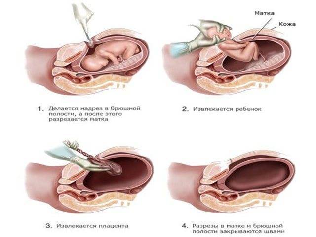Инфекционные осложнения после родов | eurolab | гинекология