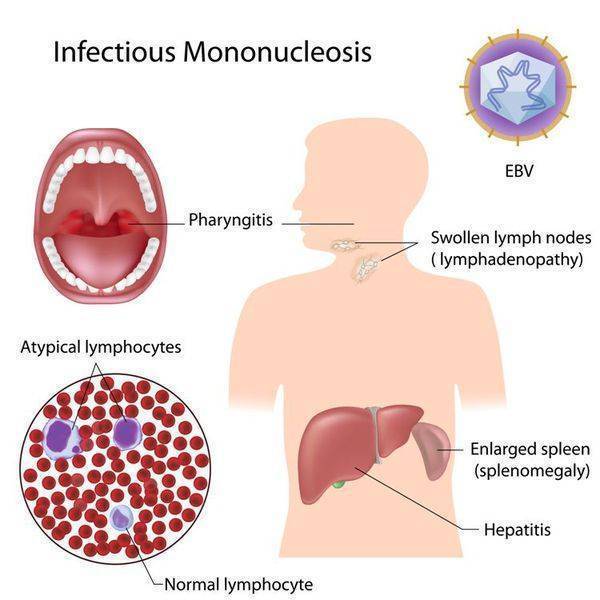 Сколько заразен инфекционный мононуклеоз?