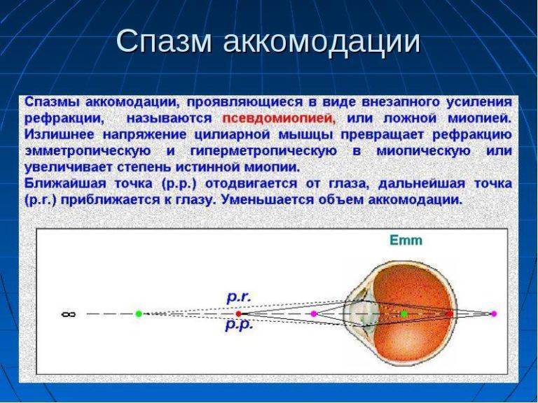 Ложная близорукость. спазм аккомодации – сахалинский центр микрохирургии глаза