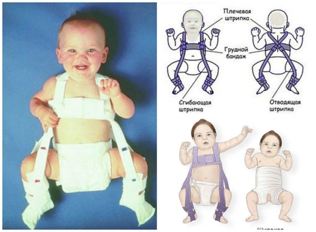 Узи тазобедренных суставов у грудничков, узи тазобедренных суставов у новорожденных: когда делать?
