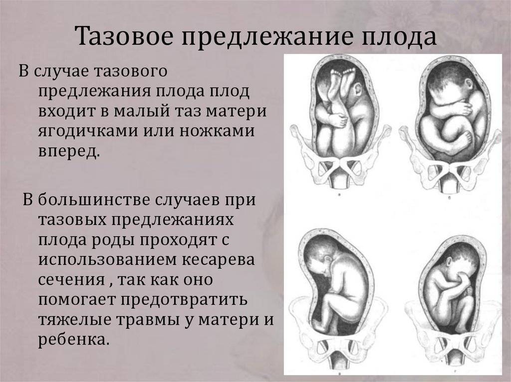 Низкое положение головки плода во время беременности: чем это плохо? головка опустилась раньше времени