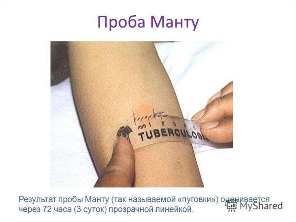 Проба манту. ранняя диагностика туберкулеза. - доказательная медицина для всех
