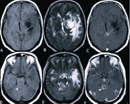 Симптомы эпилепсии: мифы и правда о болезни