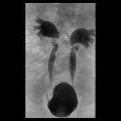 Рентгенография мочевого пузыря (цистография)