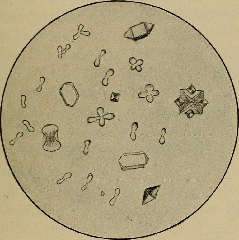 Анализ мочевого осадка: эритроциты и лейкоциты в моче