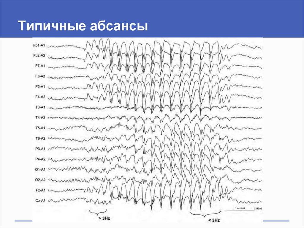 Идиопатическая эпилепсия у детей