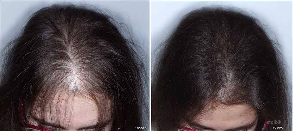 Как остановить выпадение волос после родов?