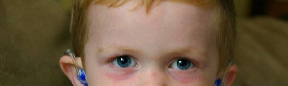 Причины синяков под глазами и способы устранения
