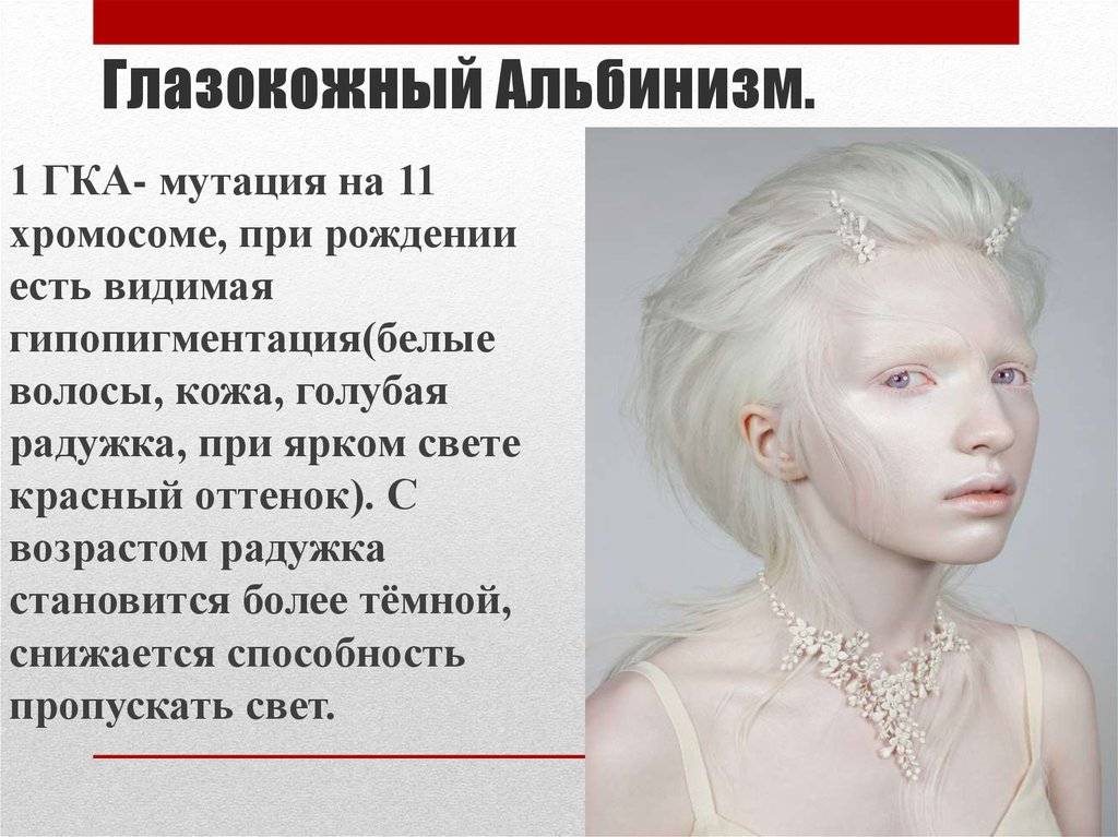 Альбинизм у человека