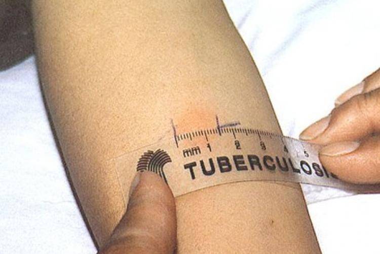 Диагностика туберкулеза: проба манту или диаскинтест