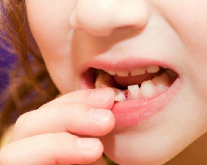 Как удалить молочный зуб в домашних условиях