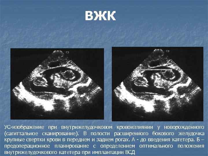 Кровоизлияние в желудочки головного мозга: причины, симптомы, диагностика и лечение