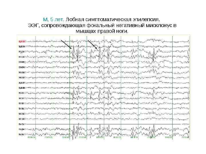 Ночной ээг мониторинг детям в москве | центр диагностики и лечения эпилепсии epihelp