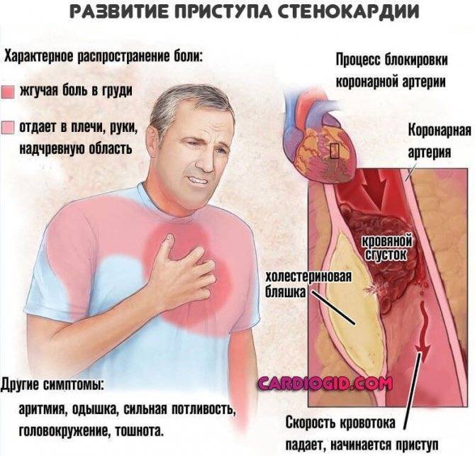 Тахикардия сердца - причины, симптомы, диагностика и лечение патологии - причины, диагностика и лечение