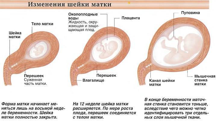 Подбор влагалищных пессариев при опущении матки и влагалища в красноярске | андро-гинекологическая клиника, ооо.