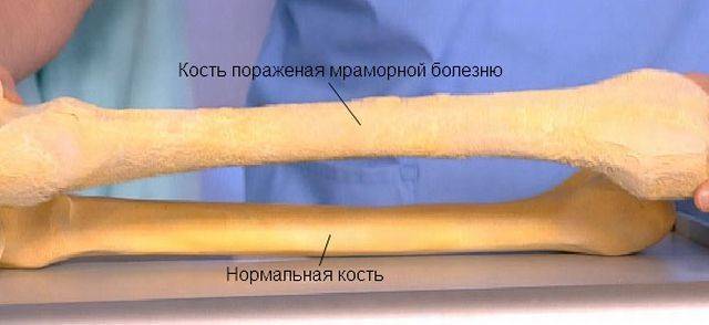 Мраморная болезнь
