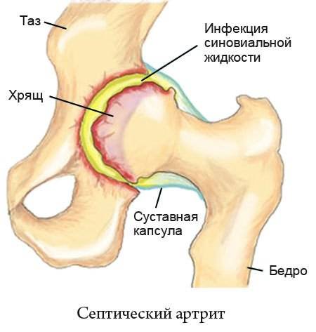 Артропатия - лечение, симптомы, причины, диагностика | центр дикуля