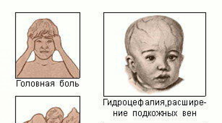Опухоль ствола головного мозга у детей