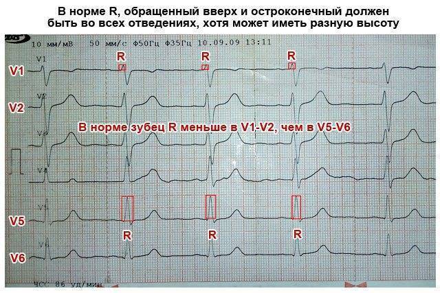 Электрокардиография (экг) сердца: нарушения ритма, блокады, отведения, теле-экг - сибирский медицинский портал