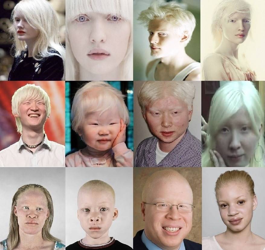 Альбинизм — википедия