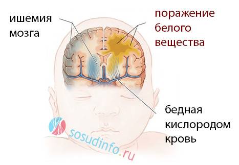 Ишемия головного мозга