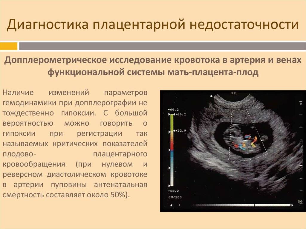 Плацентарная недостаточность у беременных с недифференцированной дисплазией соединительной ткани