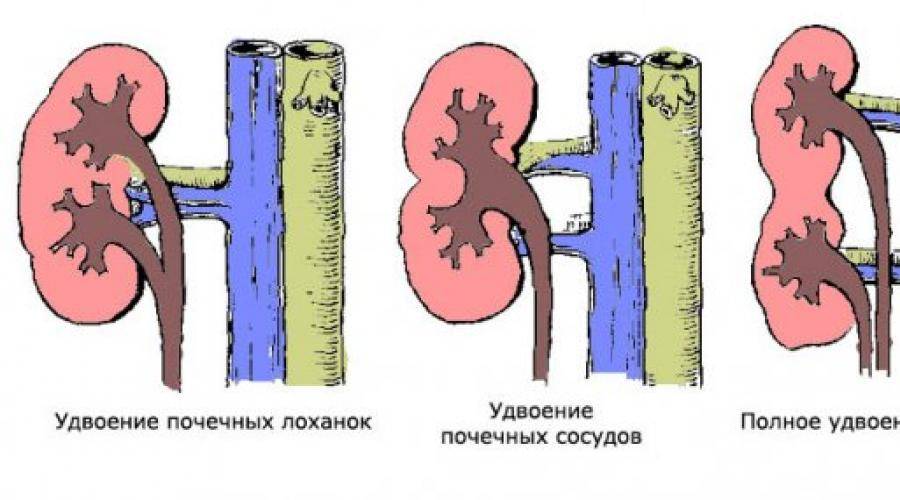 Фото удвоенной почки